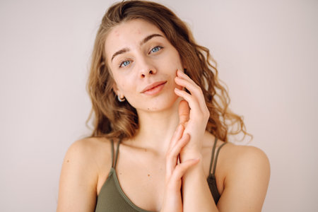 Portrait of a beautiful young woman with inflammations on the skin of her face. Acne disease.の写真素材