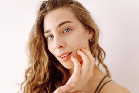 Woman no make up with red spots on her face. Skin condition. Medicine and cosmetology