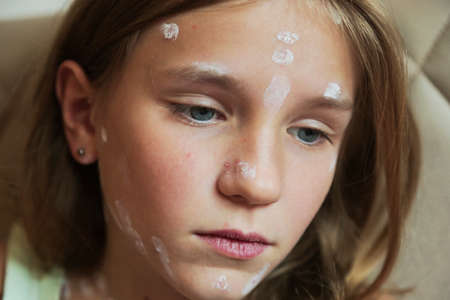 Cute little girl with chickenpox at home. Varicella zoster virus.