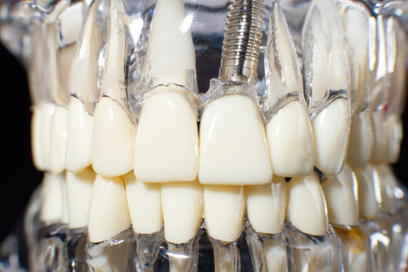 Dental jaw model over black background. Dentist dental prosthetic teeth, gums, roots close-up.