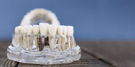 Dental Implant Model Showcasing Prosthetic Teeth on a Transparent Jaw for Educationalの写真素材