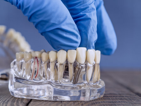 Side View of a Dental Implant Model with a Gloved Hand Adjusting Prosthetic Teeth on a Transparent Jawの写真素材