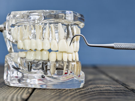 Transparent Dental Implant Model with Metal Dental Tool Demonstrating Prosthetic Teeth and Rootの写真素材
