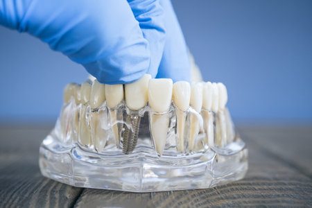 Side View of a Dental Implant Model with a Gloved Hand Adjusting Prosthetic Teeth on a Transparent Jawの写真素材