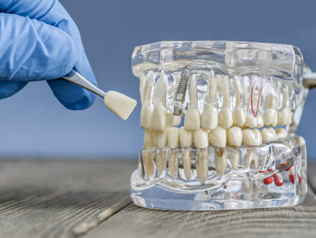 Detailed Transparent Dental Implant Model with Tweezers Holding a Prostheticの写真素材