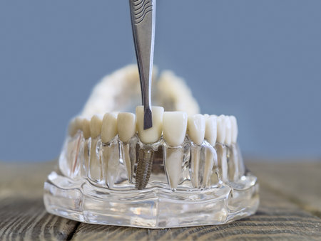 Close-up of a dental implant model with a denture being adjusted with a dental instrument for educational and demonstrationの写真素材