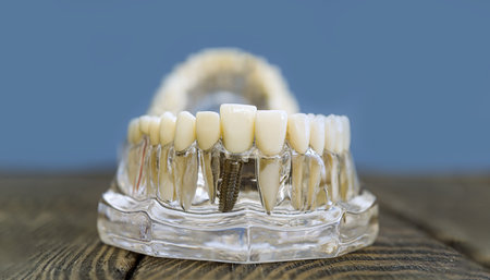 Dental Implant Model Showcasing Prosthetic Teeth on a Transparent Jaw for Educationalの写真素材