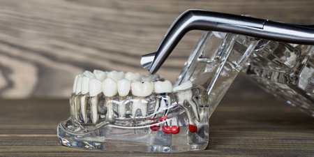 Dental root canal model with metal inspectionの写真素材