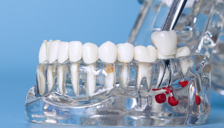 Dental implant model showing tooth crownの写真素材