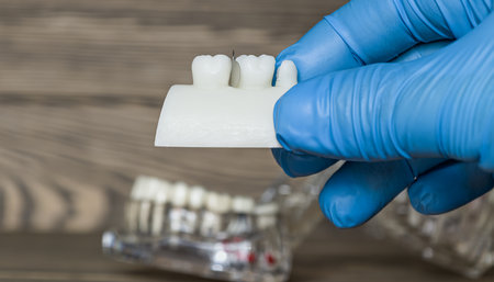 gloved hand holding a dental model showing tooth crowns, illustrating dental restoration and...