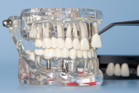 Transparent anatomical dental model showing tooth implants and a veneer beingの写真素材