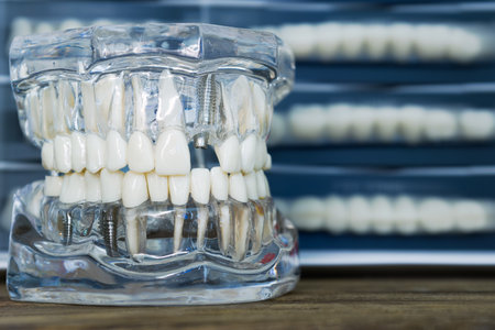 Close-up of a clear anatomical dental model displaying teeth roots, crowns, and implant posts used...