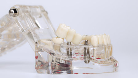 Close-up of a dental bridge being placed onto a transparent jaw model with titanium implants, used for restoration training.の写真素材