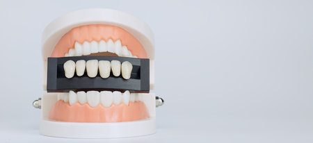 Plastic dental model holding a shade guide for dental veneers, used in cosmetic dentistry to match...