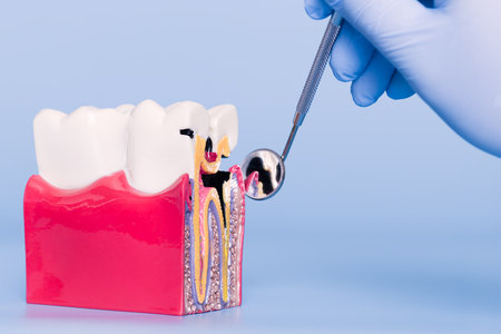 dental model displaying tooth structure and cavity, examined with a dental mirror by a gloved hand. Dental model showing tooth decay and anatomyの写真素材