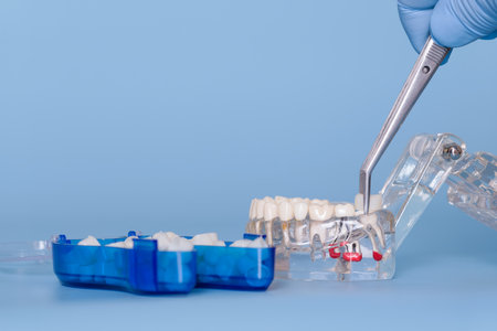 Close-up of gloved hand using tweeters to place a prosthetic tooth on a transparent anatomical jaw...