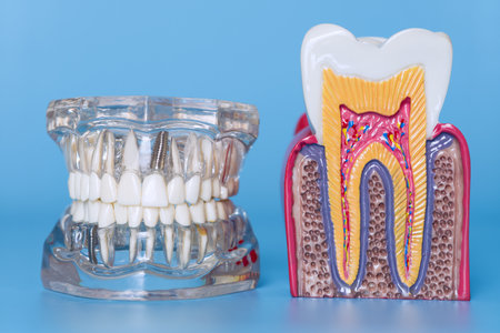 Close-up of transparent dental jaw model featuring implants beside an anatomical model showing healthy tooth structure on blue background.の写真素材