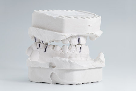 Detailed plaster dental model showing occlusal contact points used for bite analysis in orthodontic...