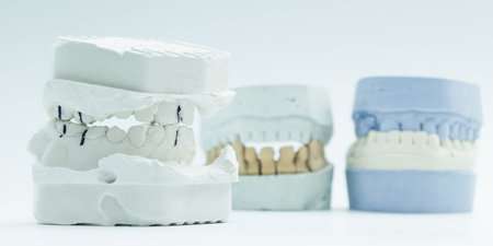 Close-up of a white plaster dental cast with occlusion markings, used in orthodontic diagnosis and...