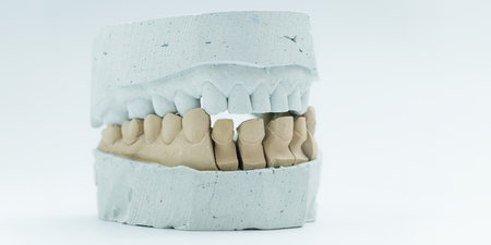 Close-up of a dental cast with shaped lower teeth ready for crowns, used in prosthodontic planning...