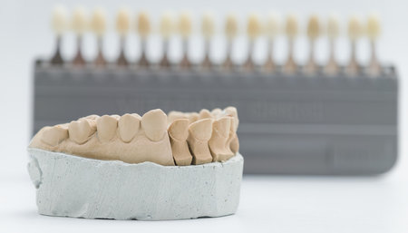 Plaster dental model displayed in front of a blurred tooth shade guide used for color matching in...