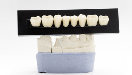 Set of artificial dental crowns displayed above a plaster model with prepared teeth, used in...