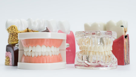 Various dental models including full dentures, transparent jaw with implants, and cross-sections showing gum disease and tooth decay.の写真素材
