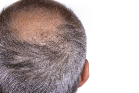 Aged man concerned with hair loss. Baldness conceptの写真素材