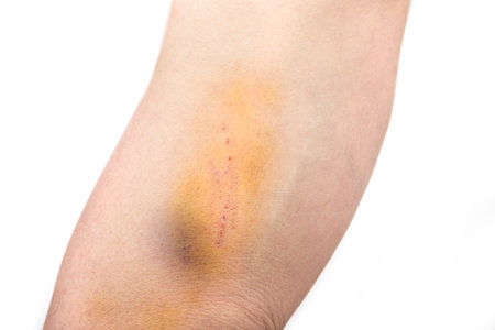 Yellow and blue bruise on a man arm