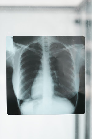 A close up of a chest x-ray of a person's lungs. The image is in black and white and the lungs are...