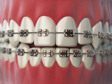 Teeth with braces or brackets in open human mouth. Dental care concept. 3d illustration
