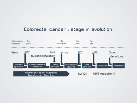 Colorectal cancer  stage in evolutionのイラスト素材