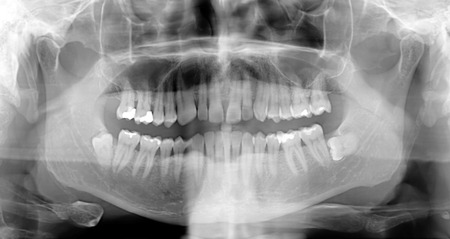 Dental X Ray