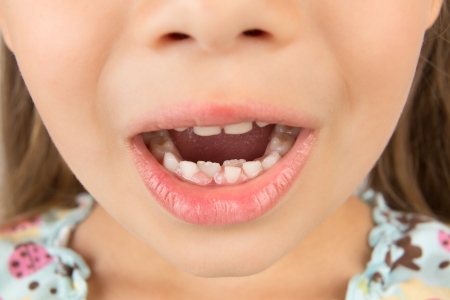 A close-up of an open mouth of a little girl showing milk teeth and two growing permanent tetth