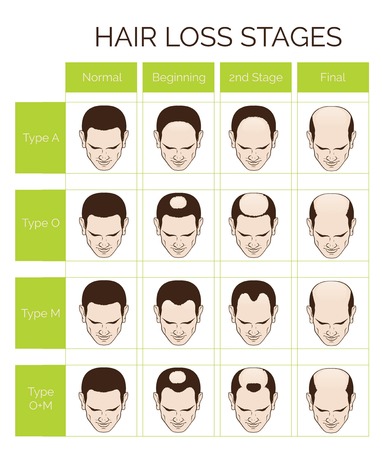 Information chart of hair loss stages and types of baldness illustrated on a male head.のイラスト素材