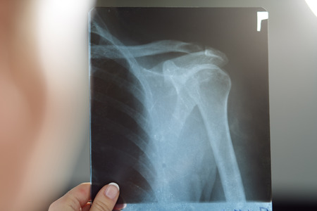 Medical doctor examines x-ray photography of patient to detect problem. Medical concept. Traumatologist holds x-ray pictureの写真素材