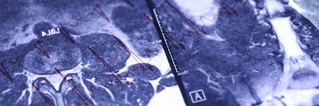 MRI image lying over cardiogram chart close-up