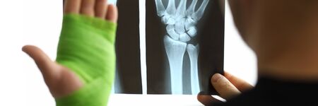 Male patient hold in hand CT scan of his broken arm at doctor appointment close-up