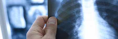 Doctors hand hold x-ray of lungs in medical office. Coronavirus infection concept