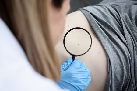 Doctor oncologist examining pigmented nevus using magnifying glass closeup. Diagnosis of skin tumors conceptの写真素材