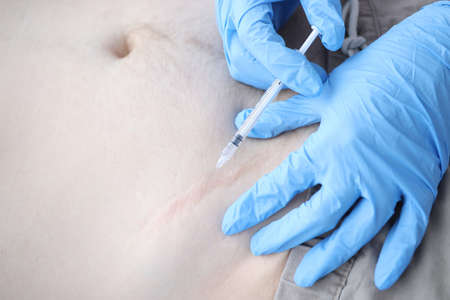 Nurse injecting medicine into patients postoperative scar closeup. Removal of scars conceptの写真素材