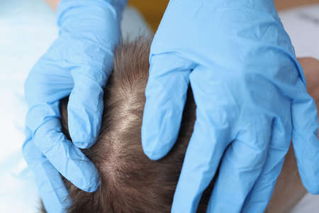 Doctor in protective gloves examining skin on patients head closeupの写真素材