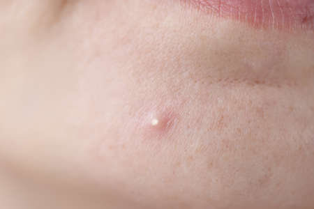 White red pimple on skin of faceの写真素材