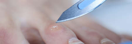 Doctor holding scalpel over corn on womans leg closeupの写真素材