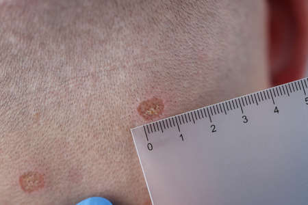 Male neck after laser removal of moles and papillomas closeupの写真素材