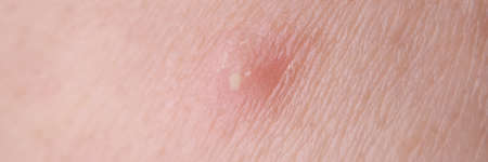 White pus pimple on skin of face closeupの写真素材