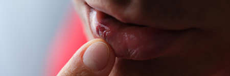 Man holding broken lip with hematoma with his hand closeup