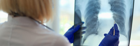 Doctor pointing at damaged area on lung x ray