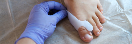 Doctor orthopedist applying brace for hallux valgusの写真素材