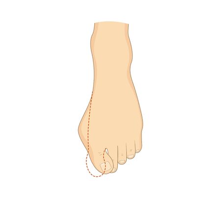 Hallux valgus surgery correction. Vector illustration. Medical orthopedicsのイラスト素材